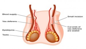 Vasectomy-reversal-surgeon-nyc-right-column-01.jpg