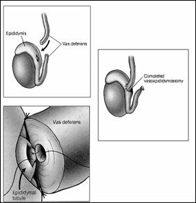 Vasoepididymostomy 