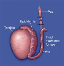 vasectomy reversal hartlepool