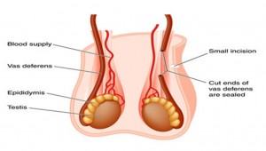 Vasectomy-reversal-surgeon-nyc-right-column-01.jpg