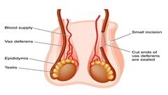 Vasectomy-reversal-surgeon-nyc-right-column-01_thumb.jpg