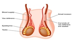 Vasectomy reversal surgeon nyc right column 01