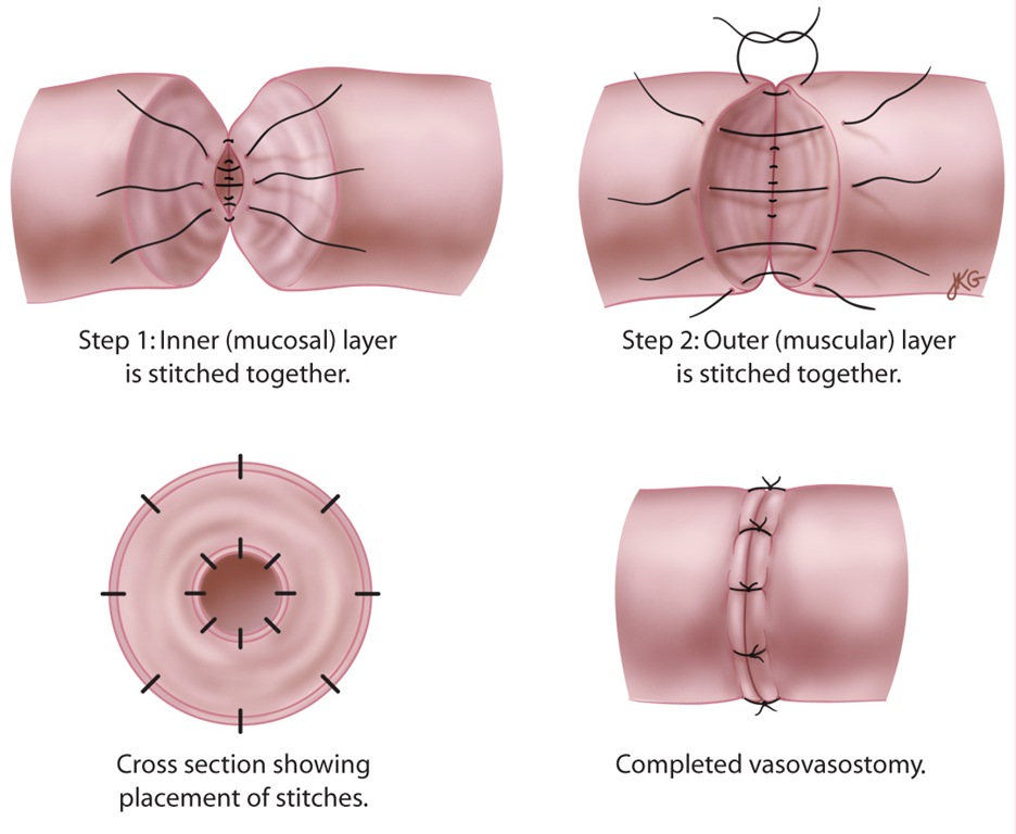 Microscopic Vasectomy Reversal-How big is a micron? - Georgia