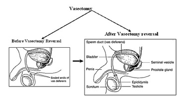 Vasectomy: Sperm Count, Recovery Time, Where to Go