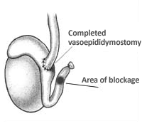 Vasoepididymostomy 