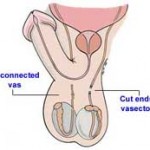 Vasectomy Reversal Success