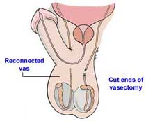 Vasectomy Reversal