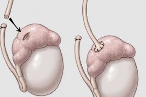 Vasectomy reversal