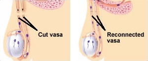 vasectomy reversal