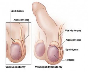 vasecotmy Reversal