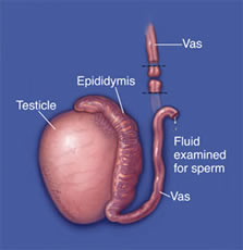 Vasectomy Reversals Just as Successful in Men Over 50 