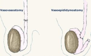 vasectomy reversal 