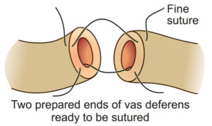 vasectomy reversal