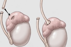 Ways to Improve Your Fertility After a Vasectomy Reversal