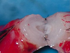 vasectomy-reversal-micro-surgery-microscope-061