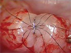 vasectomy-reversal-micro-surgery-micro-sutures-tubal-reconnect