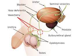 urology vasectomies best NYC